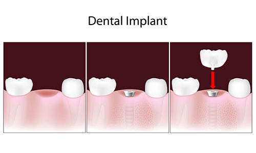 dental implants in Northbrook 