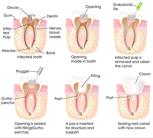 root canal in Northbrook